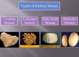 Saya sebagai pesakit batu karang dalam buah pinggang dan pundi kencing. Dr Zubaidi Hj Ahmad Jenis Jenis Batu Karang Batu Karang Atau Renal Calculi Adalah Jisim Pepejal Yang Diperbuat Daripada Kristal Ia Biasanya Berasal Dari Buah Pinggang Anda Bagaimana Pun Ia Boleh