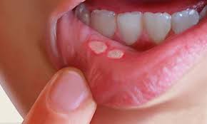 Three signs and symptoms not to ignore are: Signs And Symptoms Of Mouth Cancer Are You Mouth Aware