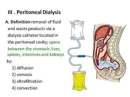 Image Result For Peritoneal Dialysis Peritoneal Dialysis Dialysis Catheter