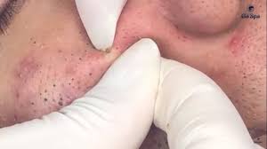 Blackhead removal by dr.lalit kasana hello everyone. Full Blackhead Popping Video Hot 2019 Part 1 Youtube