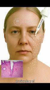 El tratamiento combinado de láser CO₂ fraccionado con nano hidroxiapatita  de calcio (CaHa) representa una estrategia avanzada para la bioestimulación  cutánea profunda y el rejuvenecimiento facial ...