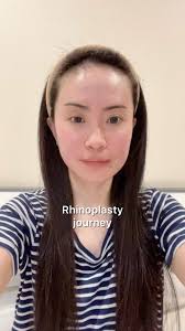 Hiatus karena ini🥹 #Rhinoplasty joourney👃🏻✨ , #dontjudge ya💕 dan mau  diabadikan di #reels 💕 anw, aku memang gamau bikin terlalu tinggi (cuma  mau enhance