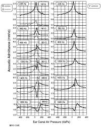 Image result for Tympanometry