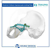 FAP Iliopubic Anterior Column Anatomic Locking Plate ...