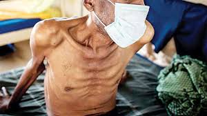 You must finish your medicine and take the drugs exactly as prescribed. Mumbai 9421 Tuberculosis Surgeries Conducted In Past Five Years At Sewri Tb Hospital