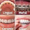 But how do you know if you need invisalign braces? 1