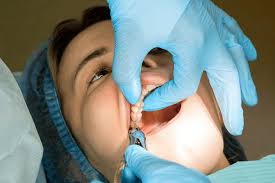 Image result for Tooth Extraction