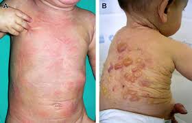 Image result for Urticaria pigmentosa children