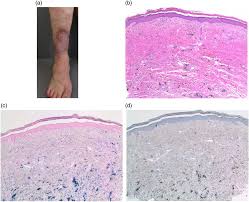 Image result for Pigment stains on the shin