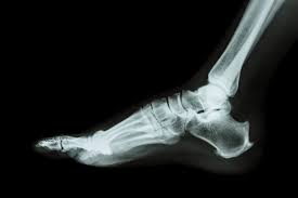 Image result for Foot XRay