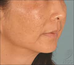 So, how does laser hair removal work? Hypopigmentation Induced By Frequent Low Fluence Large Spot Size Qs Nd Yag Laser Treatments Abstract Europe Pmc