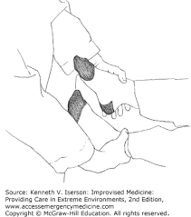 Image result for Crossed-Leg Test