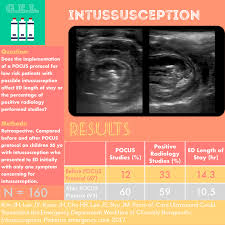 Image result for Intussusception