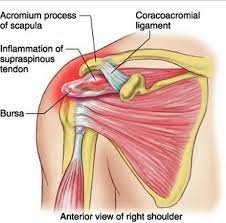 The subacromial bursa lies on the top portion of the supraspinatus tendon. Rotator Cuff Syndrome Symptoms Exercises Treatment Rotator Cuff Supraspinatus Tendonitis Shoulder Anatomy