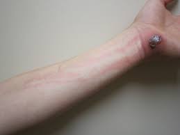 Sepsis happens when an infection triggers a potentially life threatening immune response throughout the body. Lymphangitis Wikipedia