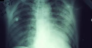 Bila cek rupanya ada jangkitan kuman kat tekak dan darah putih tinggi. Jangkitan Paru Paru Punca Simptom Dan Rawatan The Diagnosa