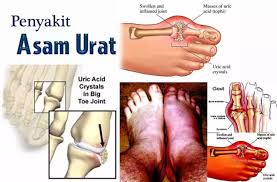 Warna merah pada bagian yang bengkak dan begitu kesemutan. Obat Nyeri Sendi Lutut Dan Kaki Radang Sendi Gejala Rematik Lutut Bengkak Asam Urat Sendi Bengkak Naturindo 100 Original Lazada Indonesia
