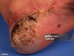 Image result for liver spots on legs