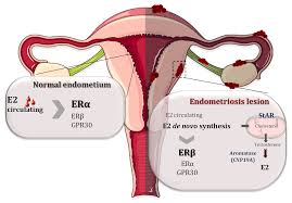 Results of a prospective, multicenter laparoscopic endometriosis surgery: Ijms Free Full Text Estrogen Receptors And Endometriosis