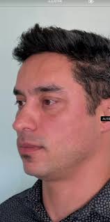 Diferença Ultraformer E Volnewer