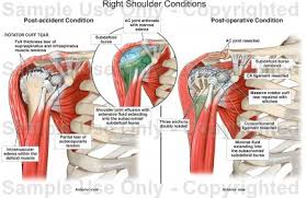 Three bones come together at the shoulder joint. Right Shoulder Conditions Medical Illustration Human Anatomy Drawing Anatomy Illustration