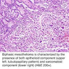 Though rare, it is important to recognise this variant and distinguish it from a pleural. Pathology Outlines Peritoneal Malignant Mesothelioma