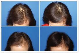 Whether they actually work is another question. Laser Cap Hair Restoration Therapy Altamonte Springs Fl Asim Medical