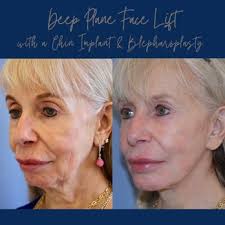 LESLIE STEVENS, MD, FACS