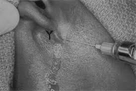 Image result for Paropsia