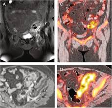 Pyrexia of unknown origin (puo), also known as fever of unknown origin (fuo), is a grouping of many unrelated medical conditions that share the feature of persistent unexplained fever despite basic investigation. Findings In Whole Body Mri And Conventional Imaging In Patients With Fever Of Unknown Origin A Retrospective Study Bmc Medical Imaging Full Text