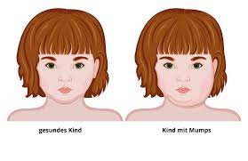 Mumps Symptome Die Typischen Anzeichen Erkennen Was Tun