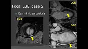 Journal of the american college of cardiology vol. State Of The Art Cardiac Mri For Myocarditis Division Of Cardiology University Of Washington