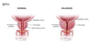 We did not find results for: Benign Prostatic Hyperplasia Bph Symptoms Diagnosis Treatment Urology Care Foundation