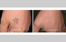 We utilize the best laser technology for. Tattoo Removal In Panama City Sun Dermatology Panama City Florida