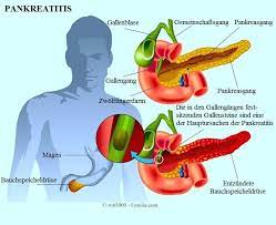 Akute Und Chronische Pankreatitis Symptome Pankreas Diat Ursachen Therapie Amylase Behandlung
