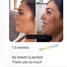 2 months after revision rhinoplasty, from Israel 🇮🇱 👉  #revisionrhinoplasty @drahmetalp.israelassistant  #revisionrhinoplastyspecialist #revisionrhinoplastyexpert #nosejob #noseart  #nasenkorrektur #rinoplastica #rinoplastia #rhinoplasty #drahmetalp ...