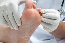 أخطرها التناسلية إليك أنواع عين السمكة وأسبابها وطرق علاجها