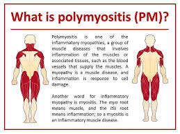 Image result for Polymyositis