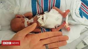 As Fotos Que Retratam A Longa Batalha De Bebe Que Nasceu Com 310 Gramas Para Deixar O Hospital Bbc News Brasil