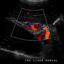 Budete přesměrováni na standardní přihlašovací stránku zču webauth, kde použijte svoje orion uživatelské jméno a heslo. Cavernous Transformation Of The Portal Vein Radiology Reference Article Radiopaedia Org