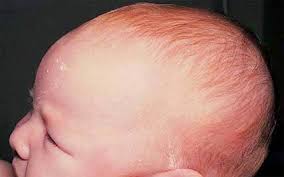 Medictests Com Ar Twitter Bulging Fontanelles Bulging Fontanelles Are Common While An Infant Is Crying Vomiting Or Lying Down If They Are Truly Bulging While The Infant Is Calm And Upright This Indicates