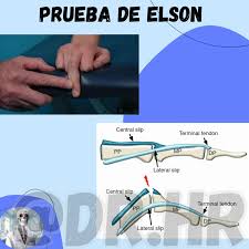 Image result for Elson Extensor Tendon Test