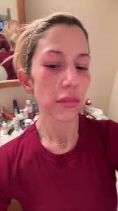 #reaction #allergicreaction #fyp