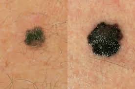 Skin cancer can have the appearance of clearing in the center or around the. When To Worry About Moles On Your Child Different Types And Skin Cancer Risks Lifestyle News Asiaone