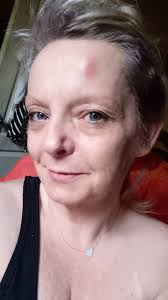 Stroke survivor overcomes leg lifting challenge