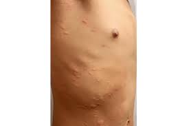 Maybe you would like to learn more about one of these? Covid Toes Rashes How The Coronavirus Can Affect Your Skin