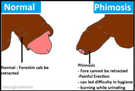 Image result for Phimosis