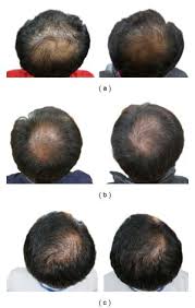 People usually cut pronor pill into 4 quarters so there is. Finasteride 5mg Hair Loss