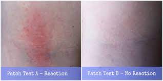 Do not apply the color and advise them to see their doctor before coloring their hair again. Hair Dye Patch Test Reaction