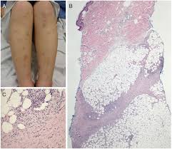 Image result for Panniculitis